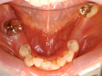 インプラント治療　3