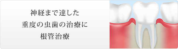 神経まで達した重度の虫歯の治療に根管治療