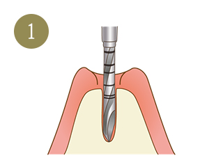 インプラント治療の手順