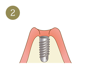 インプラント治療の手順