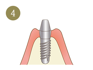 インプラント治療の手順