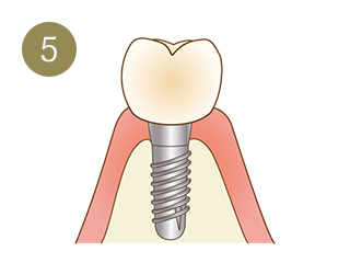 インプラント治療の手順