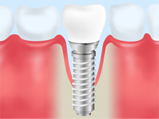 インプラント周囲炎とは