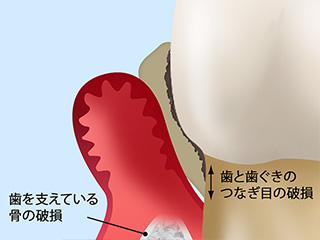 歯周病とは