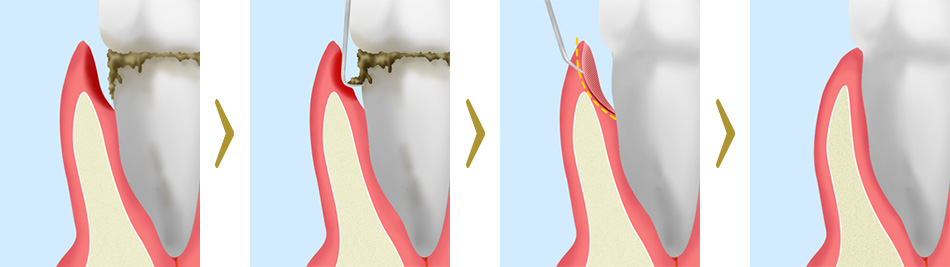 歯周ポケットそうは術