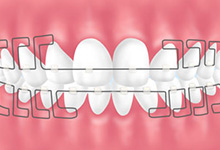 二歯までの部分矯正