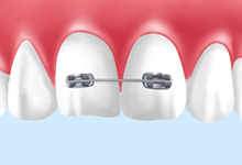 二歯までの部分矯正