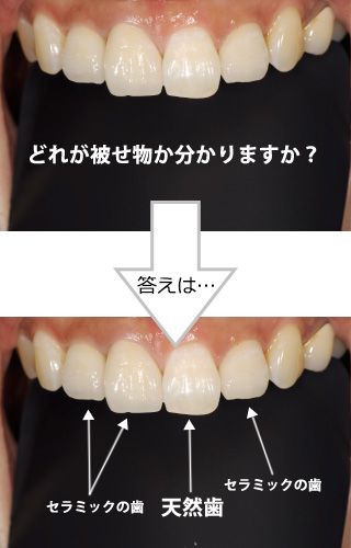 どれが被せ物かわかりますか？