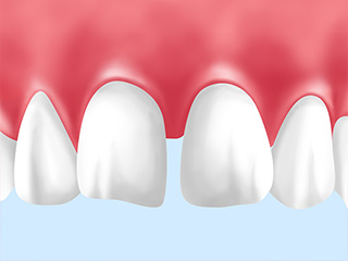 「前歯の形が気に入らない」という方に