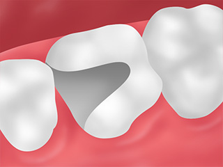 「金属の詰め物や被せ物が取れてしまった」という方に