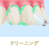 オフィスホワイトニング